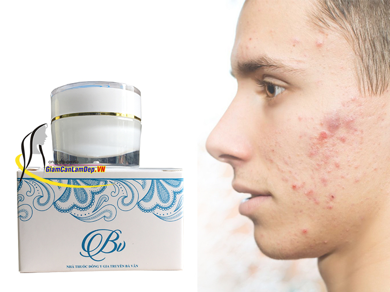 Kem Đông Y Đa Năng Bà Vân - Đặc Trị Mụn và Các Bệnh Ngoài Da